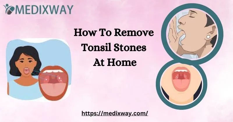 How To Remove Tonsil Stones At Home
