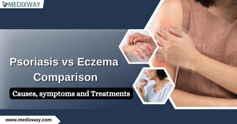 Psoriasis vs Eczema