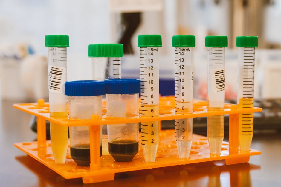 Medical urine sample cups showing different color shades related to hydration and medication effects