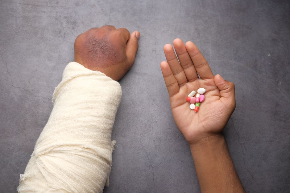 Person with arm in a cast managing pain during broken bone recovery with hydrocodone